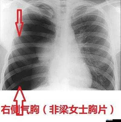 100%胸片曝光率软件，可直接观看，无任何限制